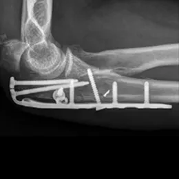 Example one of other products requiring multiple horizontal proximal screws (Compared to Proximal Ulna Plate)