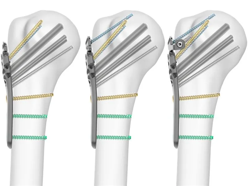 Proximal Humerus Fixation System in bone model