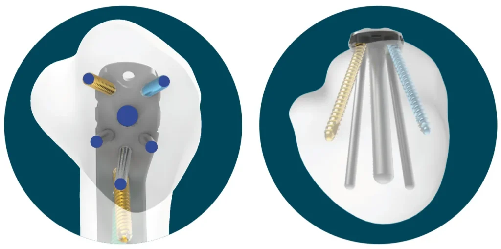Aerial and side view of the Proximal Humerus Fixation System