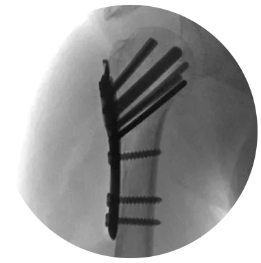 Proximal Humerus Fixation System X-ray