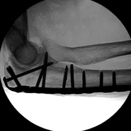 Proximal Ulna Plate X-Ray