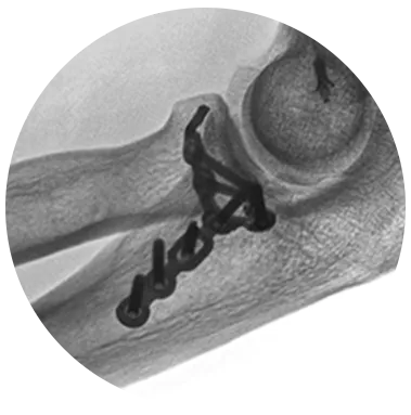 Protean® Fragment Plate X-Ray