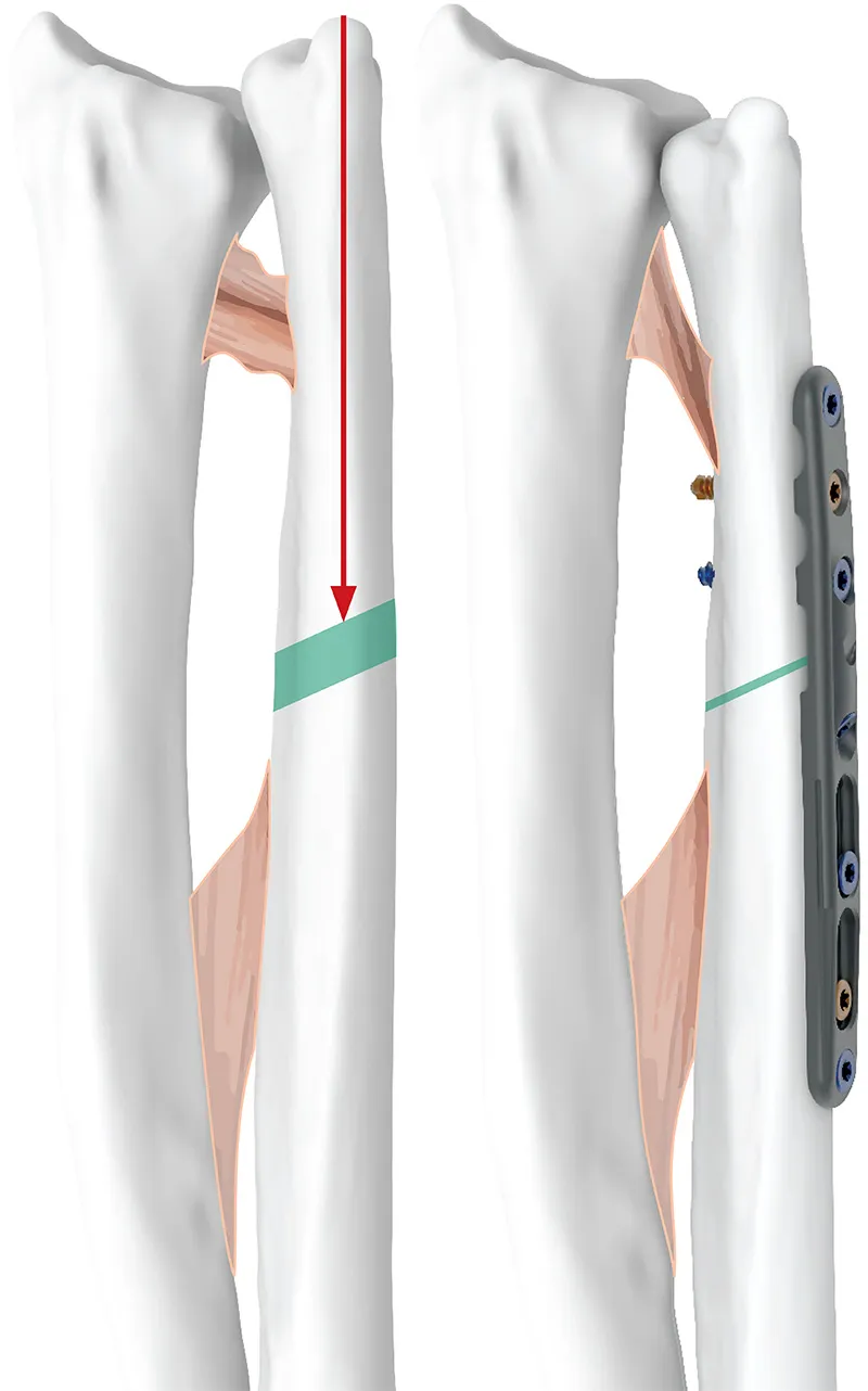 Increases tension on distal interosseous ligament to enhance DRUJ stability