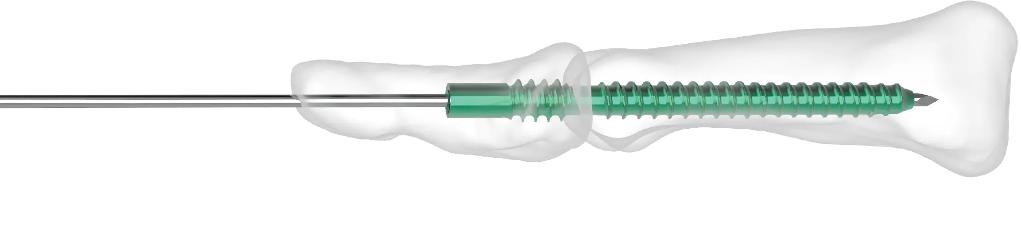 Diagram of implants designed to address common clinical issues