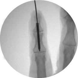 X-Ray view of REDUCT® arthrodesis screw system