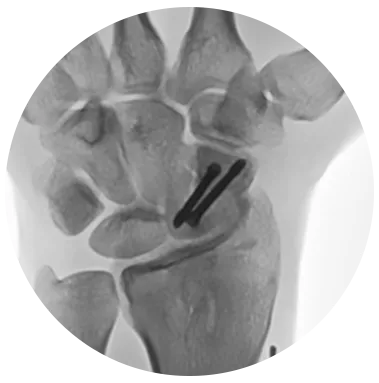 REDUCT® Headless Compression Screw Hand X-ray