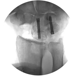 headless compression screw x-ray view one