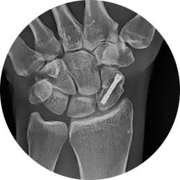 headless compression screw x-ray view two