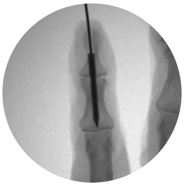 REDUCT® Arthrodesis Screw X-ray