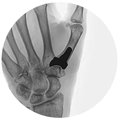 STABLYX® X-ray for cmc arthroplasty system