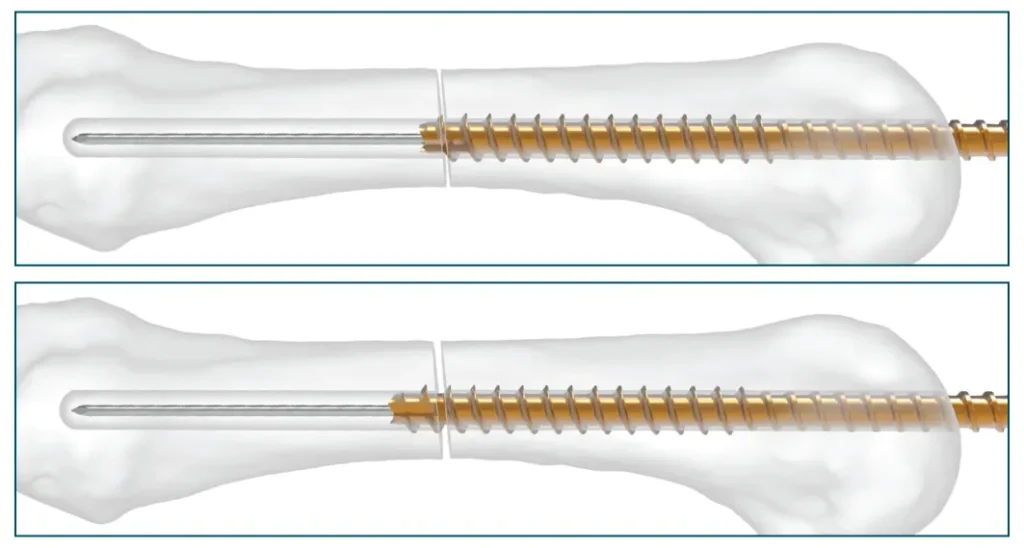 Designed to achieve a fully reduced and stable fracture repair