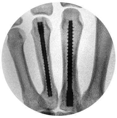 Threaded Hand Nail System X-ray