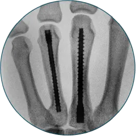 3rd & 4th metacarpal repaired with 3.5 x 45mm & 4.5 x 50mm Threaded Hand Nails