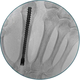 2nd metacarpal fracture repaired with 4.5 x 40mm Threaded Hand Nail