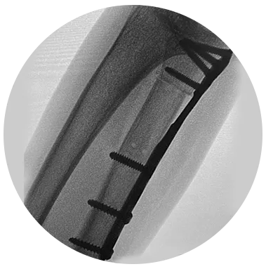 FREEFIX® Ulna Shortening Plate xray