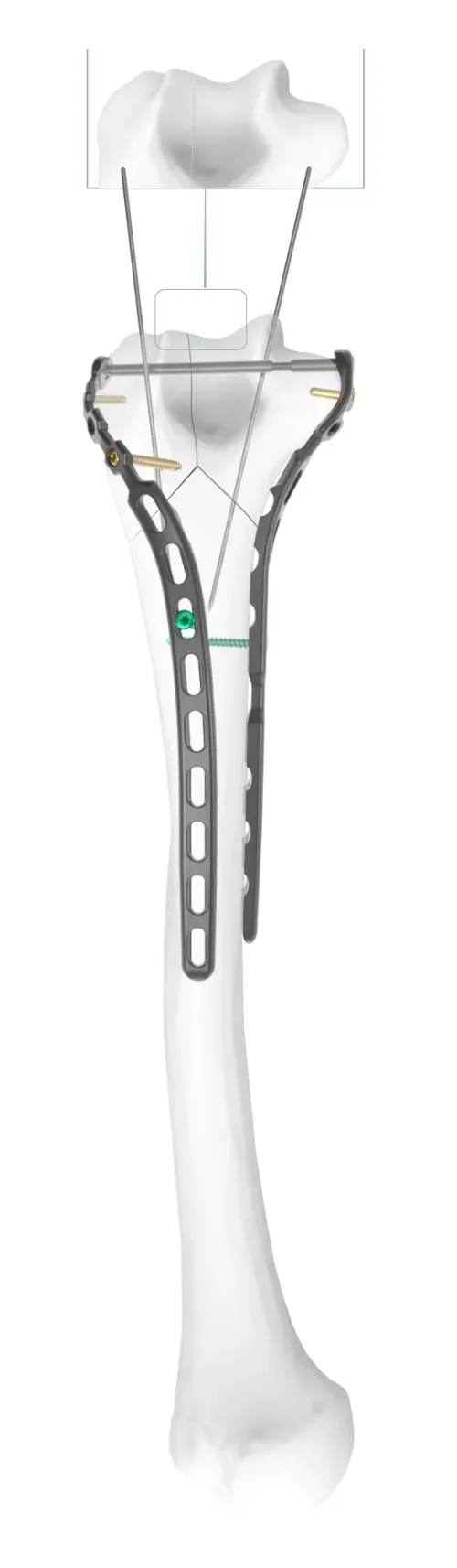 Step 6 of TiBeam® technology.