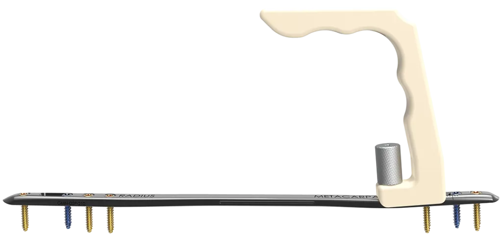 Dorsal Spanning Plate Handle with Construct