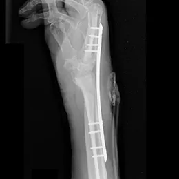 Dorsal Spanning Plate X-Ray View