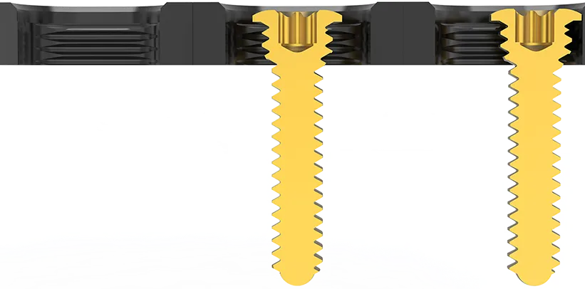 1.5mm of dynamic compression per slot