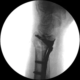 rotating the wrist under fluoroscopy for the Geminus® plating system