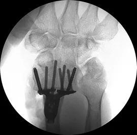 a tangential x-ray view of the Geminus® plating system