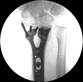 a 20˚ elevated lateral fluoroscopic view for the Geminus® plating system