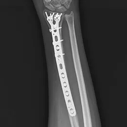 1.5mm of dynamic compression per slot X-Ray View 1