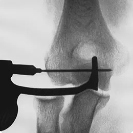 Centering guides pinpoint the axis of rotation - X-Ray view