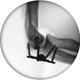 Low profile construct X-Ray view 2