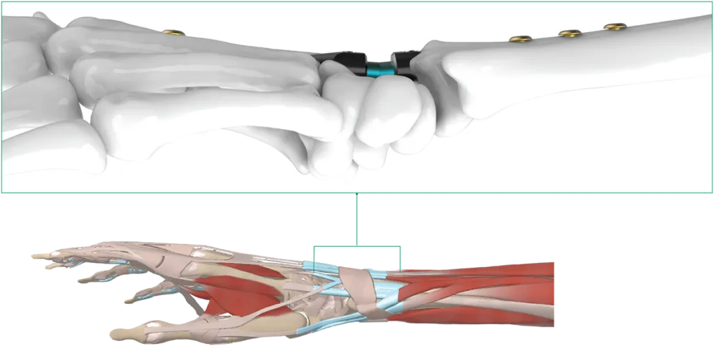 Intramedullary placement minimizes soft tissue irritation