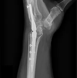 IMPLATE® Wrist Fusion Nail X-Ray View