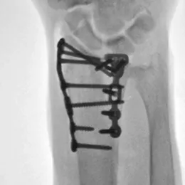 Low profile, indication-specific options designed for optimal subchondral support - X-Ray View 1