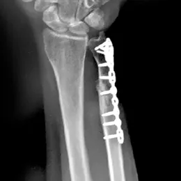 Low profile, indication-specific options designed for optimal subchondral support - X-Ray View 2