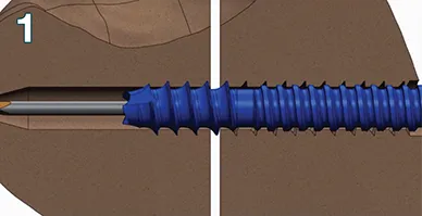Distal threads engage the distal fragment