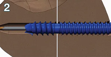 Thread relief clears the fracture site