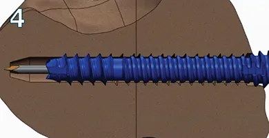 Slippage occurs preventing over compression