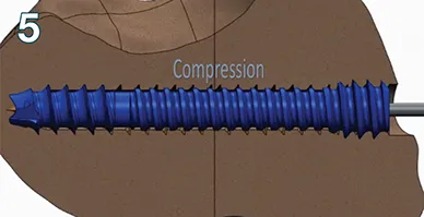 Attains 1mm of final compression when proximal all threads engage the proximal fragment