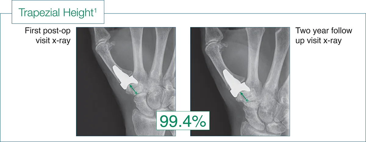 The percentage (%) of trapezial height maintained at 24 month follow-up
