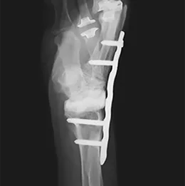 Alternate Wrist Fusion Plating Construct X-Ray View