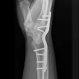 Alternate Wrist Fusion Plating Construct X-Ray view 2