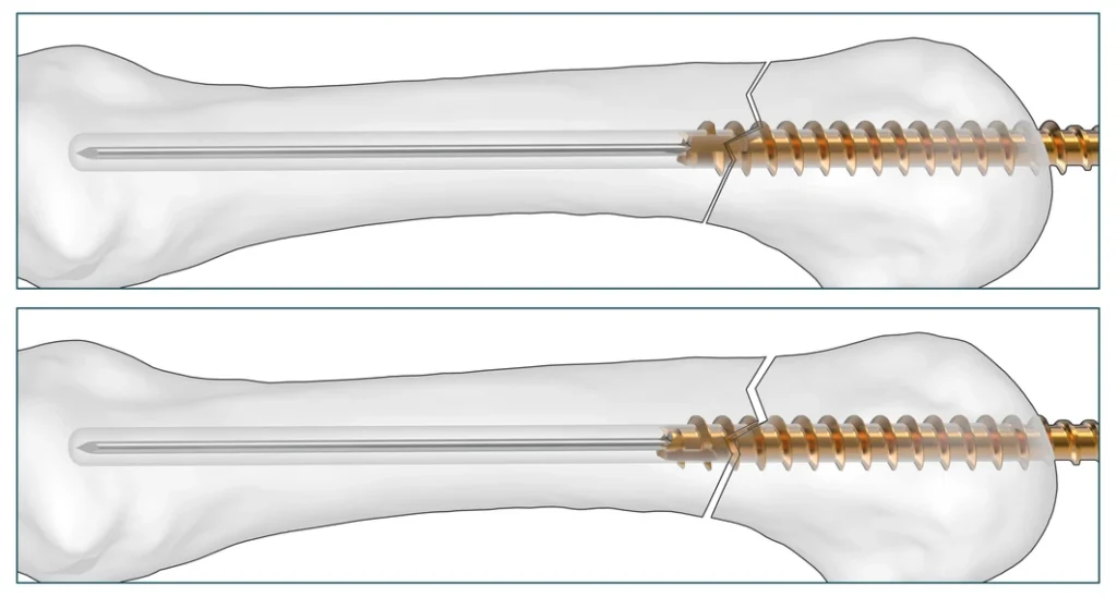 Threaded Hand Nail crossing the fracture line, showing potential distraction
