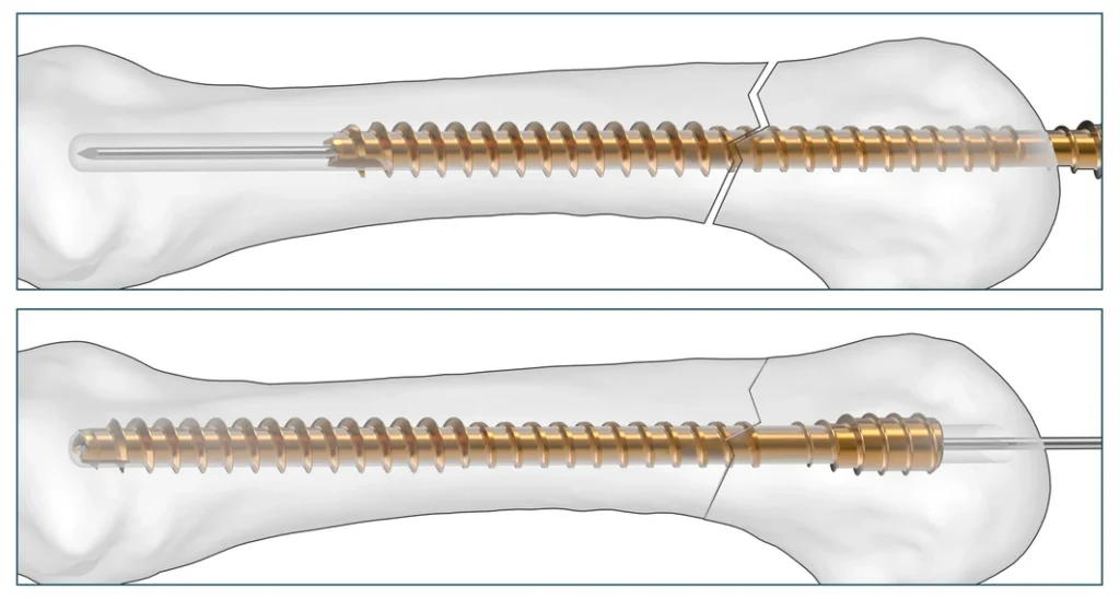 Threaded Hand Nail crossing the fracture line as compensatory translation closes the gap with Net Zero Compression